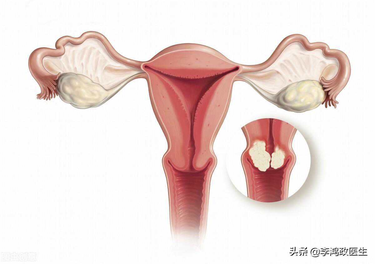25岁女子宫颈癌被切除子宫，医生深度分析：宫颈癌的治疗和预防