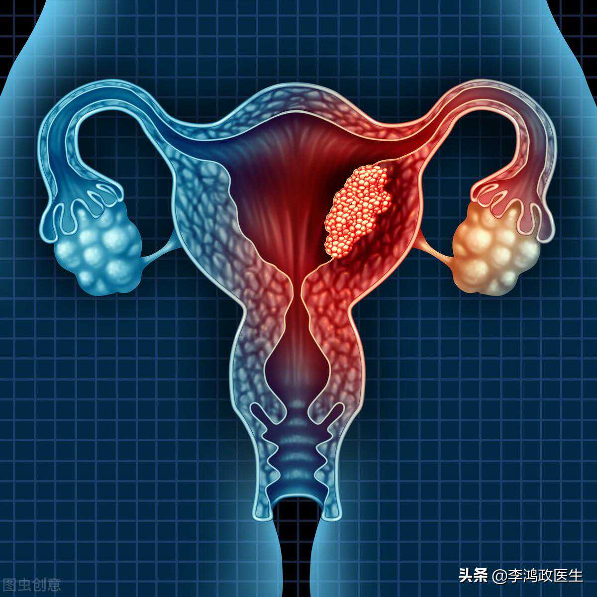 25岁女子宫颈癌被切除子宫，医生深度分析：宫颈癌的治疗和预防